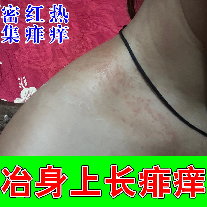 天热引发身上红点大片疙瘩刺痒长密集疙瘩舒缓植物喷剂