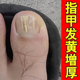 脚指甲发黄变厚变硬分层真菌性白甲专治空指甲的药甲床分离修复液