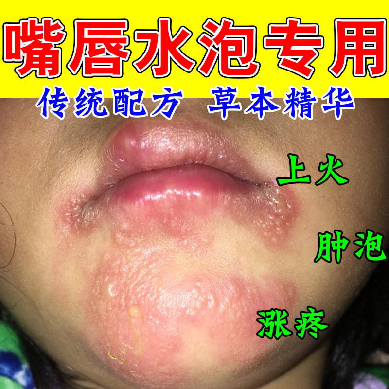 唇水泡口角上火嘴唇干裂嘴唇起水泡上火嘴角红肿疼痛唇上火保湿膏