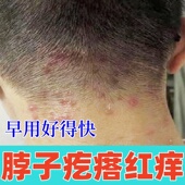 脖子痒过敏性皮肤痒皮严刺挠颈部发红起疙瘩脖子后面痒出汗痒药膏