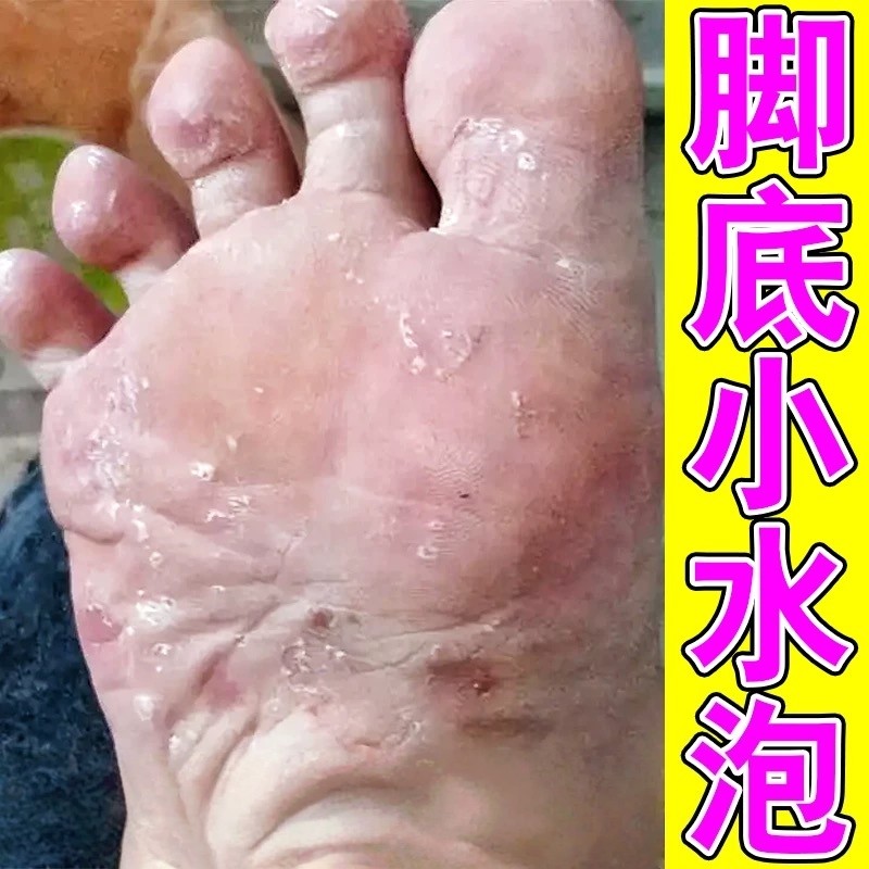 脚底上起小水泡又痒又脱皮治脚脱皮肤消毒护理（消）