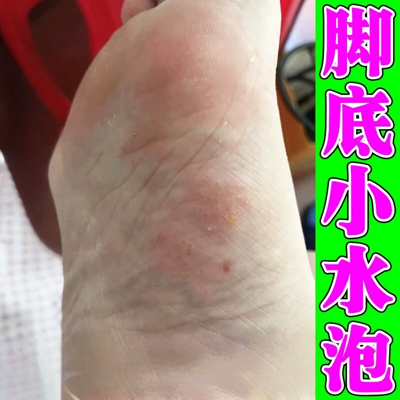脚底起小水泡又痒又脱皮起小水泡皮肤消毒护理（消）