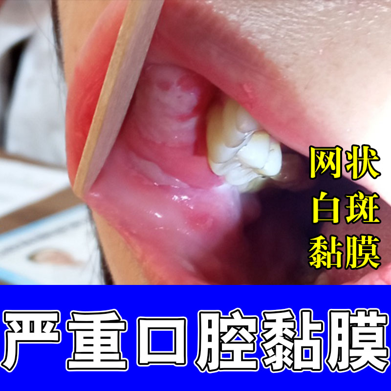 嘴巴白斑黏膜口腔纤维化表层黏膜口腔纤维化白斑草本喷剂