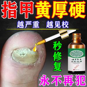 脚指甲发黄变厚增厚变硬真菌性白甲空甲床分离修复灰甲治疗专用药