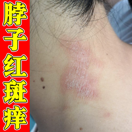 脖子红斑痒过敏皮肤干燥粗糙起皮掉屑痒修复脖颈后面发红刺挠疙瘩