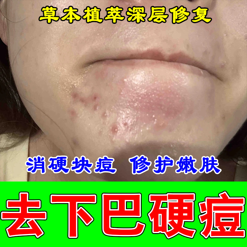 冶下巴痘闭口小疙瘩小颗粒脸部熬夜上火长痘粉刺外用保湿乳膏