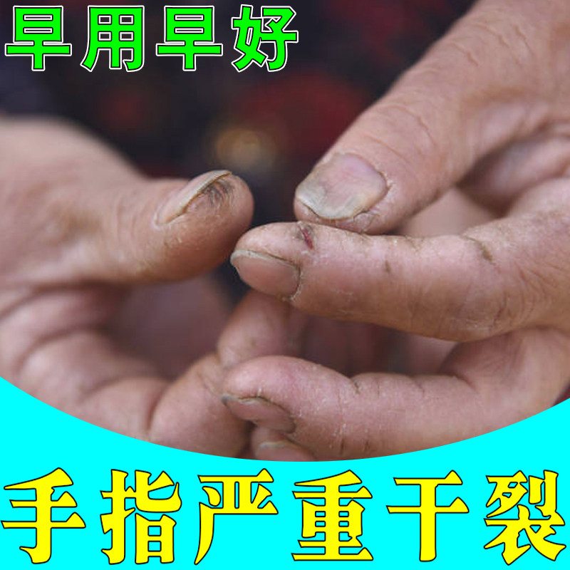 手指头严重干裂起皮专用真菌蜕皮手干裂皮肤干燥粗糙裂口子掉皮膏