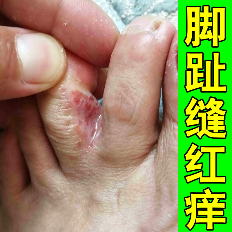 脚趾缝红痒潮湿长小水泡红点脚出汗真菌脚痒药外用修复脚缝痒软膏