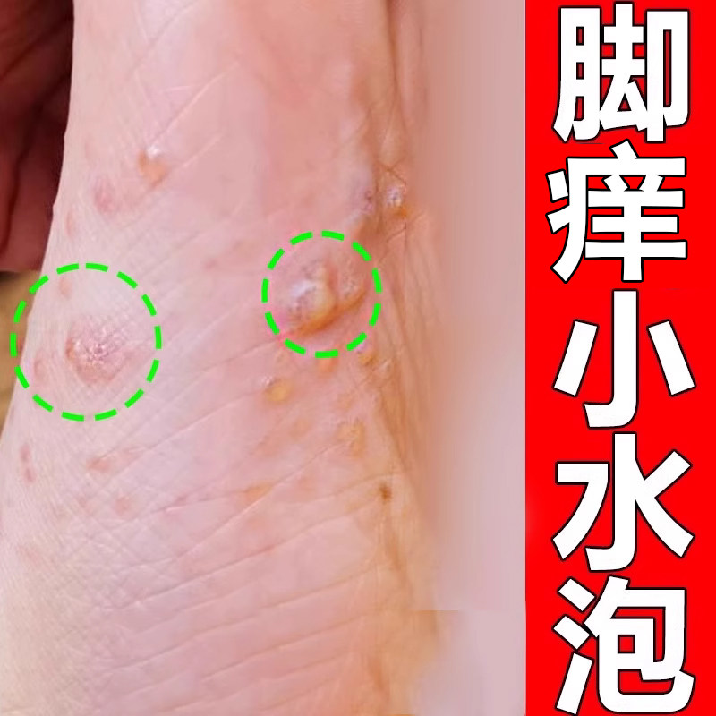 脚上起皮脚上脚蜕皮脚丫脚干燥粗糙喷雾剂