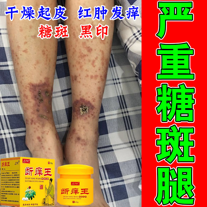 老年人腿部糖斑肌肤干痒难受小腿脚上大块褐色斑疙瘩痒植物养护膏