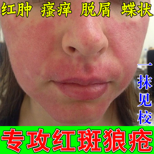 系统红斑狼疮外用药抗敏红用于脸部皮肤红斑蝶状红斑膏