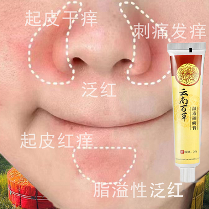 鼻子两侧脂溢性泛红干燥起皮刺痛发痒鼻翼两边发红掉皮屑脱皮软膏