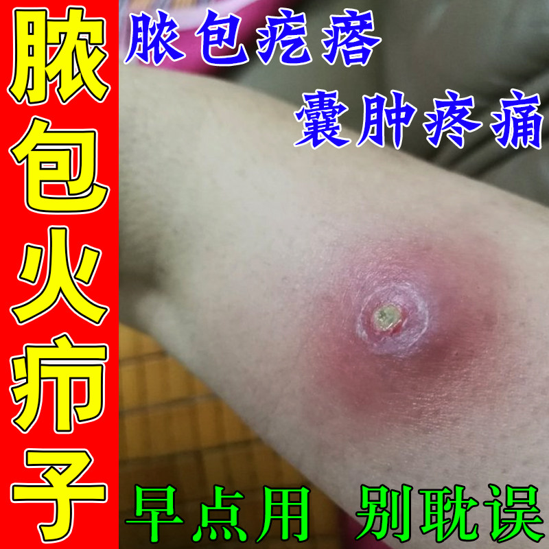 身上火疖子硬块疙瘩囊肿包流脓溃烂疼痛火疖子专用