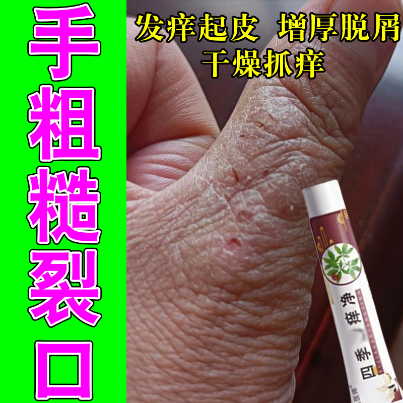 手关节硬痒手上长粗糙硬疙瘩真菌干裂脱皮痒出汗起屑抓挠痒修护膏