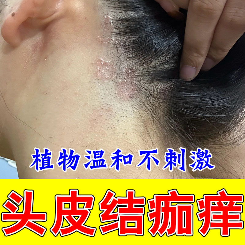 头皮干痒红肿结痂白屑起皮粗糙头上起屑不适肌肤保湿植萃膏