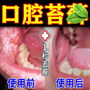 口腔扁平内壁长网状白斑口腔纤维化修复口腔黏膜白斑灼热疼喷雾剂