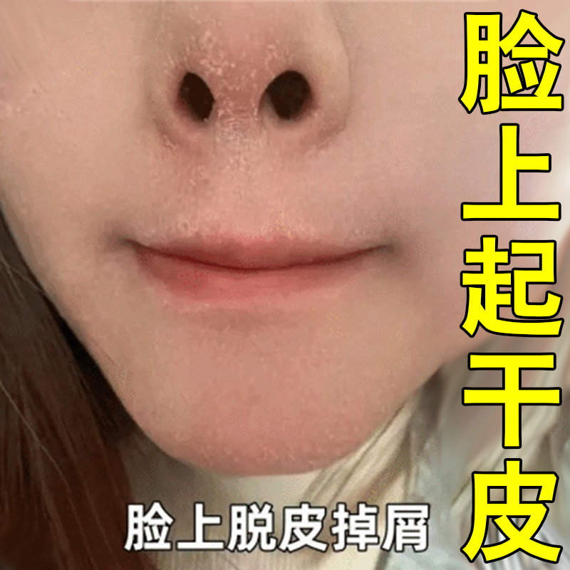 脸上起皮干燥脸干脱皮干痒鼻子两侧起干皮脸上过敏泛红脸掉皮屑痒