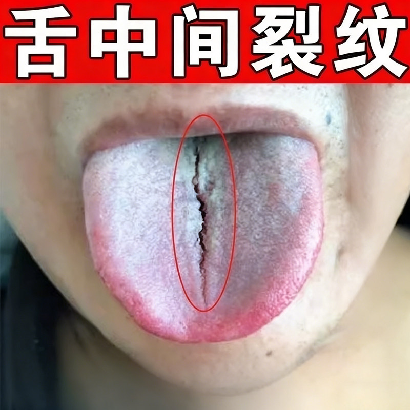舌头中间裂纹有齿痕舌苔白厚黄腻地图舌舌开裂疼痛外用喷雾剂,保健用品,皮肤消毒护理（消）,淘宝优惠券,粉丝福利购,淘宝优惠卷