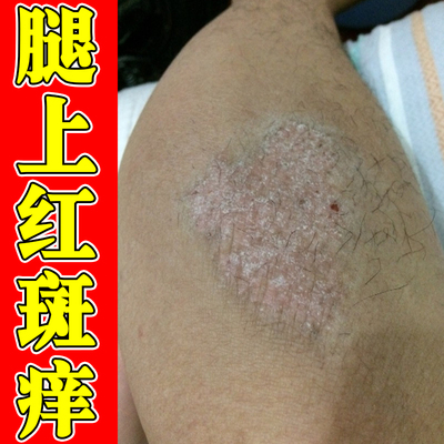 腿上疙瘩痒换季一抓就痒身上痒起疙瘩小腿痒长小点痒喷雾