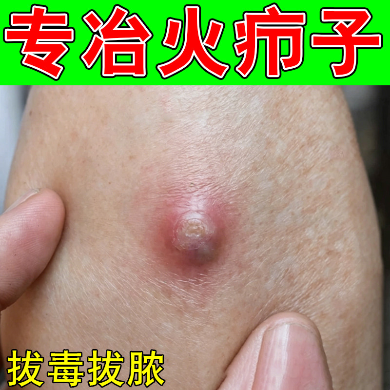 火疖子乳药身上长硬块疙瘩红肿豆豆红包囊肿疖子脓包疼痛外用软膏