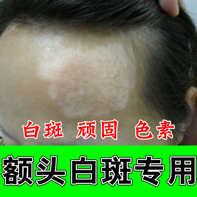 脸上长白斑白块成人脸部额头有小白点白色斑块汗斑花斑痒专用膏