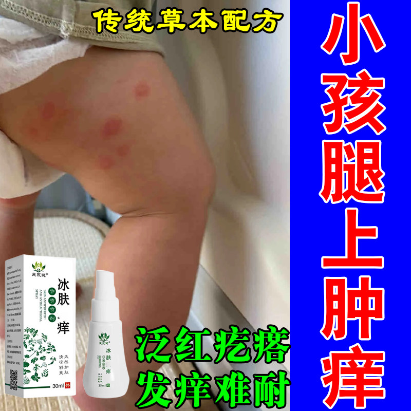 冶小孩身上蚊虫叮咬痒起红肿疙瘩痒蚊虫叮手臂胳膊小腿痒草本喷剂