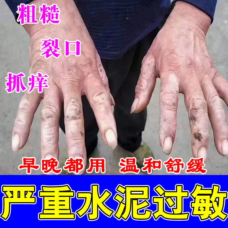 水泥过敏建筑工人手粗糙脱皮干裂起白屑保湿干燥手植物温和舒缓膏