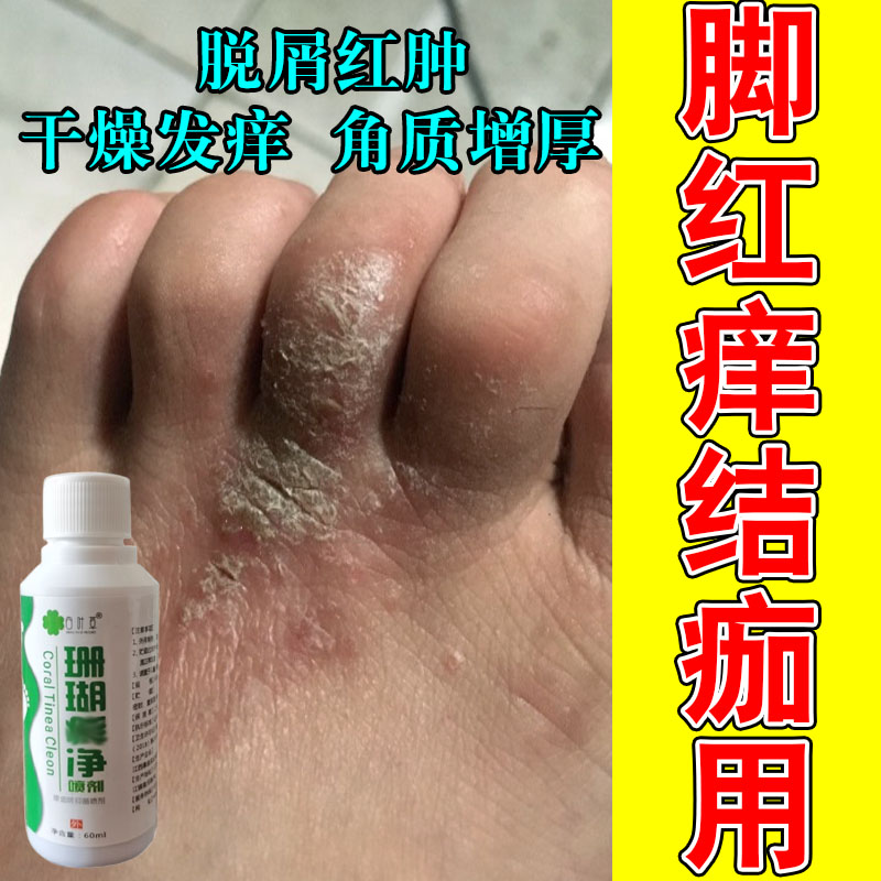 脚趾头粗糙皮肤干硬痒脱皮真菌发黑起硬疙瘩脚指痒起皮干燥草本膏