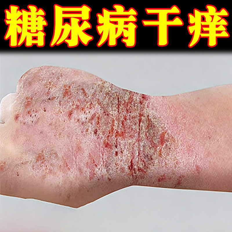 糖尿干痒外用修复膏手腕皮肤干燥掉皮屑抓挠引起结痂粗糙痒老年人