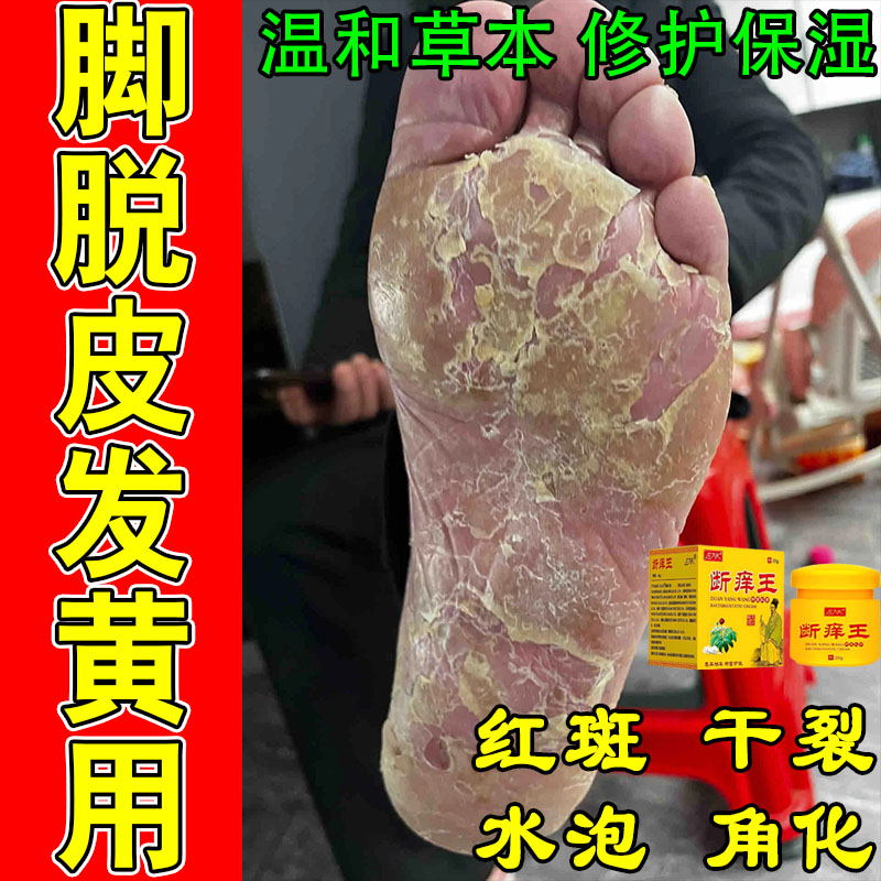 掌跖手足手脚干燥粗糙起皮干裂脱皮泛红角质增厚外用护肤乳膏
