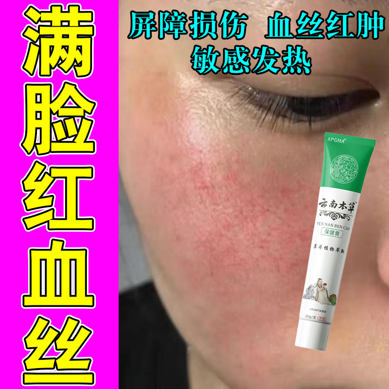 脸上红血丝严重过敏发红敏感脸上泛红红血丝草本修护乳膏
