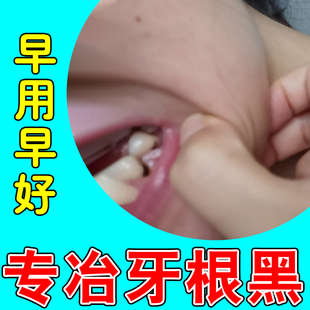 牙根发黑的药牙菌斑牙缝发黑牙黄牙垢洗牙粉清理神器