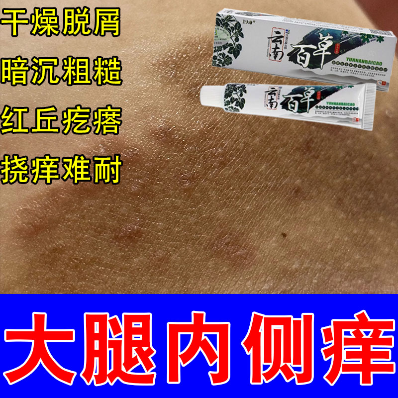 屁股内侧皮肤痒大腿痒内侧长红痘痒疙瘩真菌腿部粗糙起屑修护膏