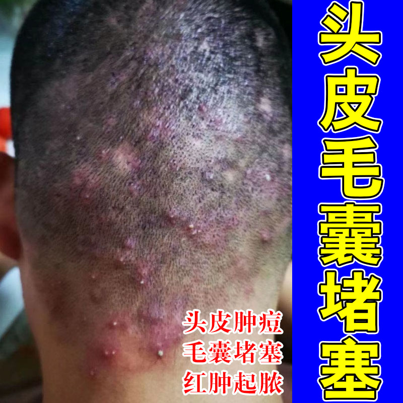 头皮毛囊疙瘩长痘头干燥发痒红疙瘩头上长痘硬块脂草本专用软膏