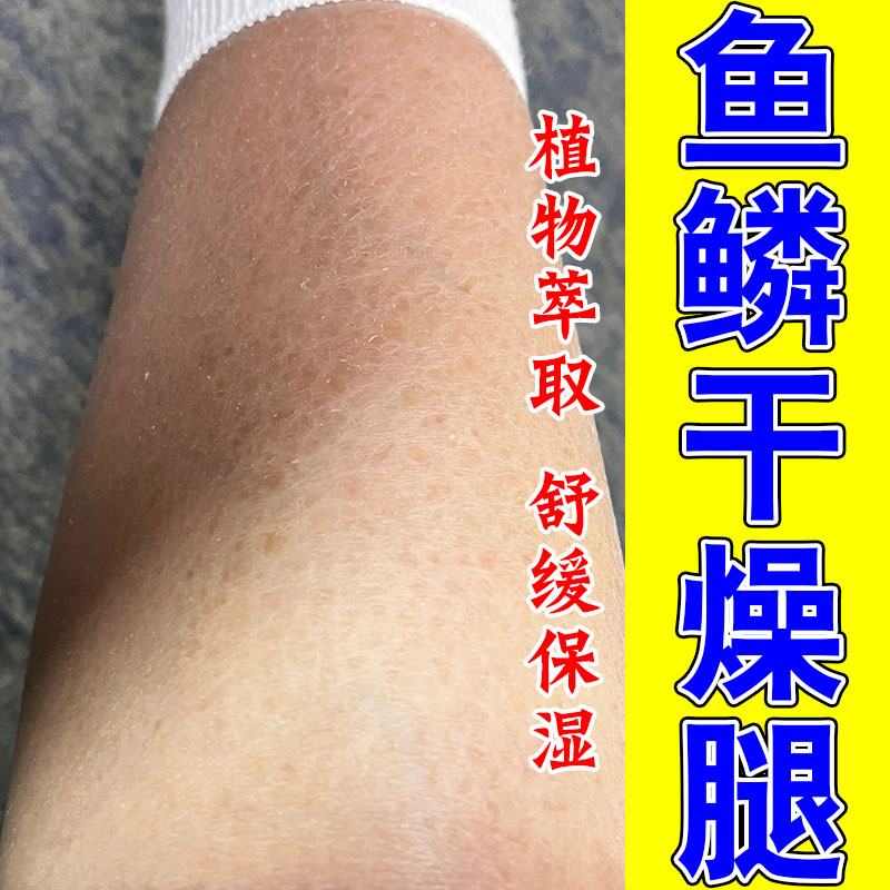 小腿全身皮肤干燥鱼鳞脱皮起皮屑干皮保湿身体甘油