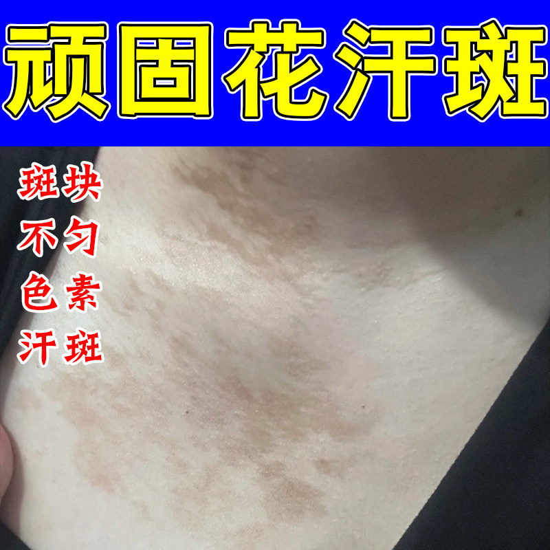 汗斑花斑乳膏专用去汉班净后背上长黄深色斑点痒皮肤白斑软膏