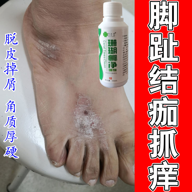 脚趾关节上起皮干燥治脚趾头痒干燥起皮红斑皮疙瘩修护软膏