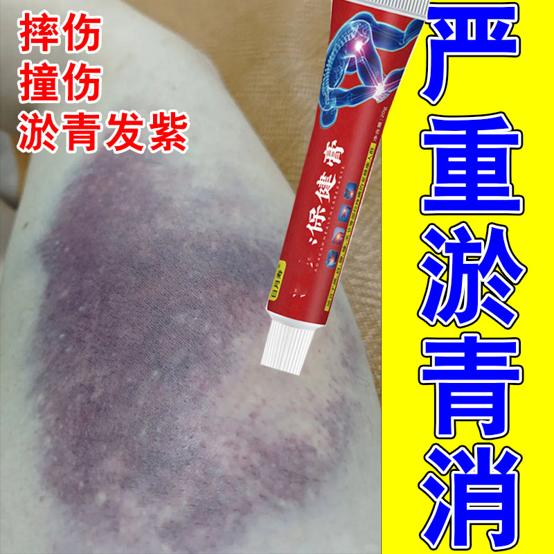 冶腿上淤青膝盖腿磕碰撞伤乌黑发紫红肿疼痛散淤活血化瘀专用膏