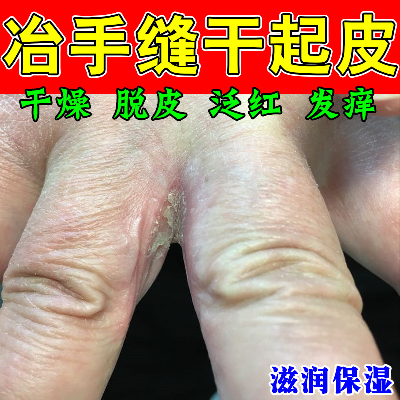 手指缝脱白皮渗水痒手丫经常碰水指缝脱皮开裂起水泡痒起皮修护膏
