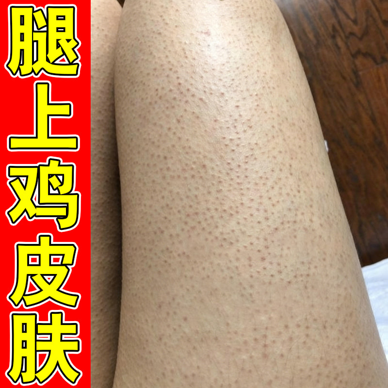 腿上鸡皮疙瘩毛周角化症身上长小黑点毛囊堵塞粗糙干燥外用修复膏