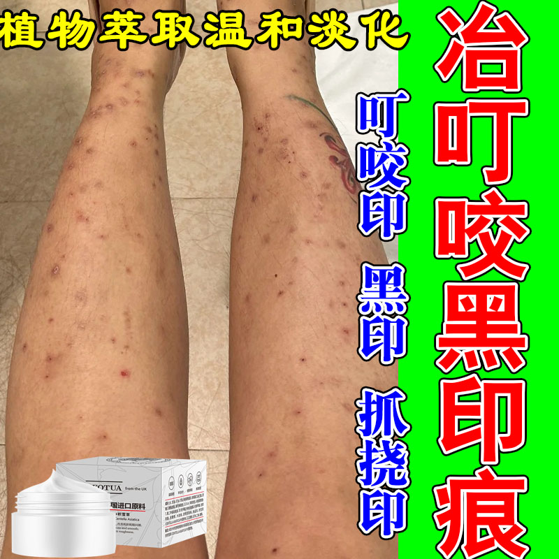 去腿上黑印蚊虫叮咬黑色素沉淀黑印抓挠深色积雪草舒缓淡化膏