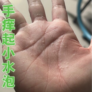 手痒起水泡手掌脱皮鹅掌风药汗疱诊湿痒疹手上起小水泡止汗状泡疹