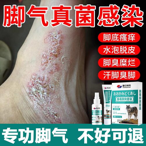 狼毒脚气喷剂雾臭烂丫脱皮