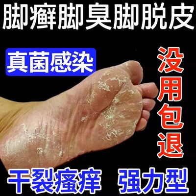 脚癣足癣一次净官方旗舰店脚气止痒脱皮杀菌去真菌感染专用喷剂oa