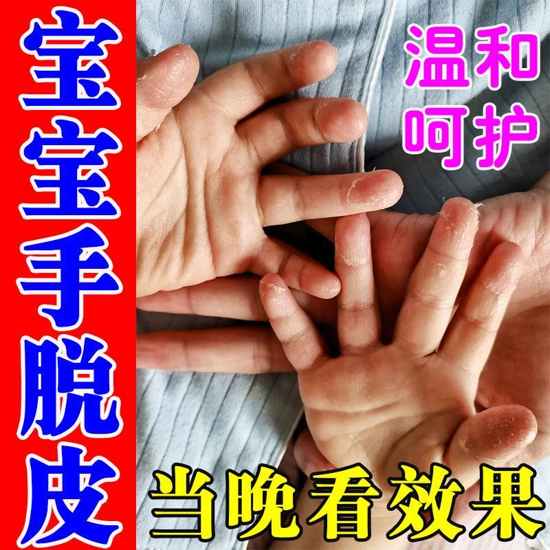 儿童手足脱皮膏手指掉皮专用药膏小孩子季节性手脚严重蜕皮维生素