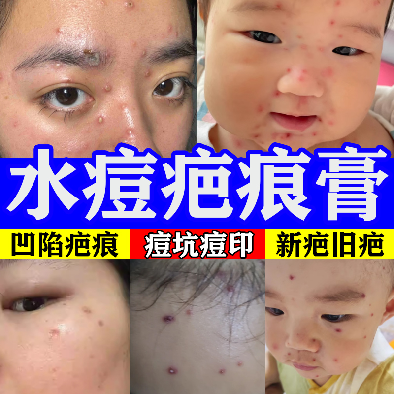 【800%修复水痘疤痕】一抹消除