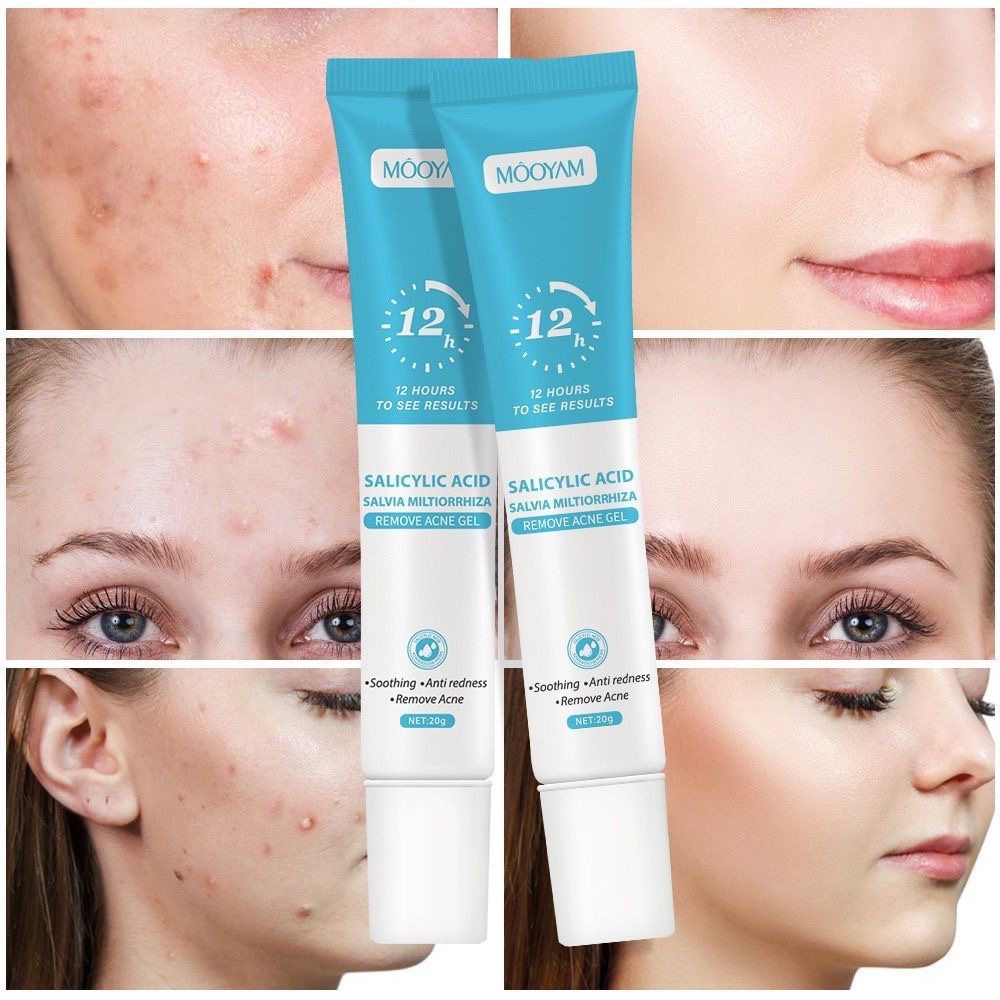 20g Salicylic Acid Acne Removal Cream Acne Treatment Moistur