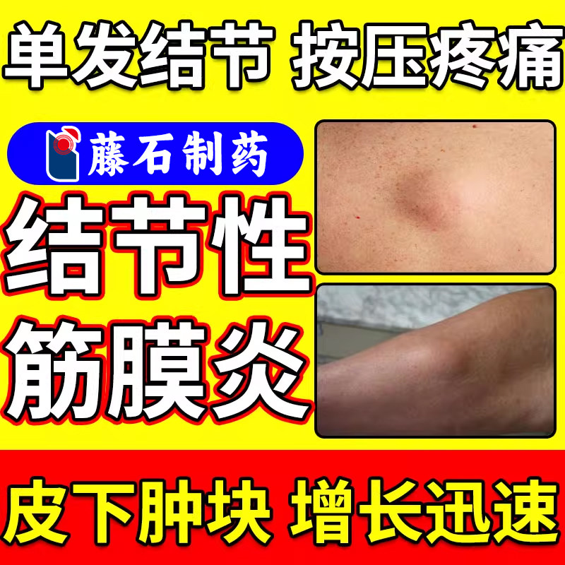 结节性筋膜炎小腿手臂筋疙瘩硬块肌肉拉伤硬结疼痛可搭膏药贴AH