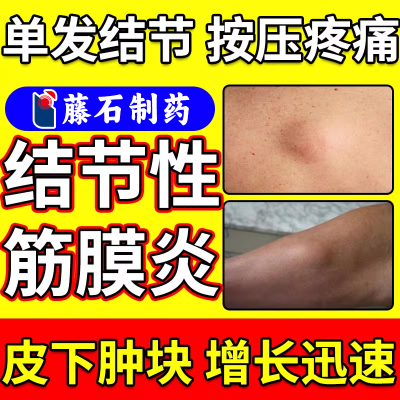 结节性筋膜炎小腿手臂筋疙瘩硬块肌肉拉伤硬结疼痛可搭膏药贴AH