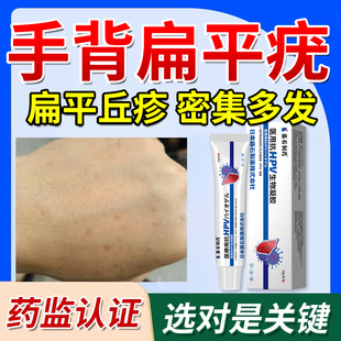 去手背扁平疣软膏专丝状疣瘊小肉粒一抹灵除药房同售水医用AH